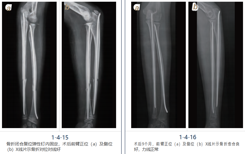 儿童尺桡骨干骨折弹性髓内钉技术（看完这篇就够了）