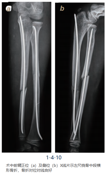 儿童尺桡骨干骨折弹性髓内钉技术（看完这篇就够了）