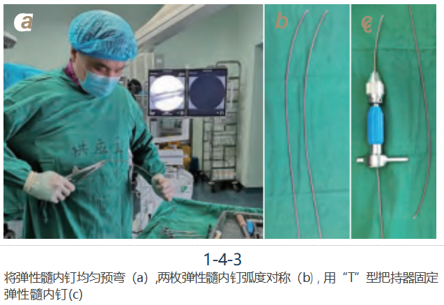 儿童尺桡骨干骨折弹性髓内钉技术（看完这篇就够了）