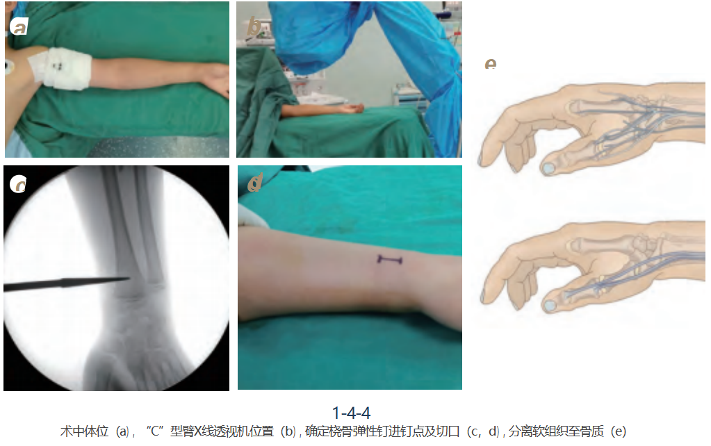 儿童尺桡骨干骨折弹性髓内钉技术（看完这篇就够了）