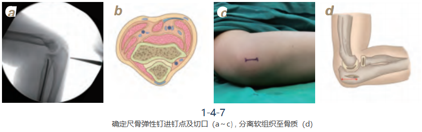 儿童尺桡骨干骨折弹性髓内钉技术（看完这篇就够了）