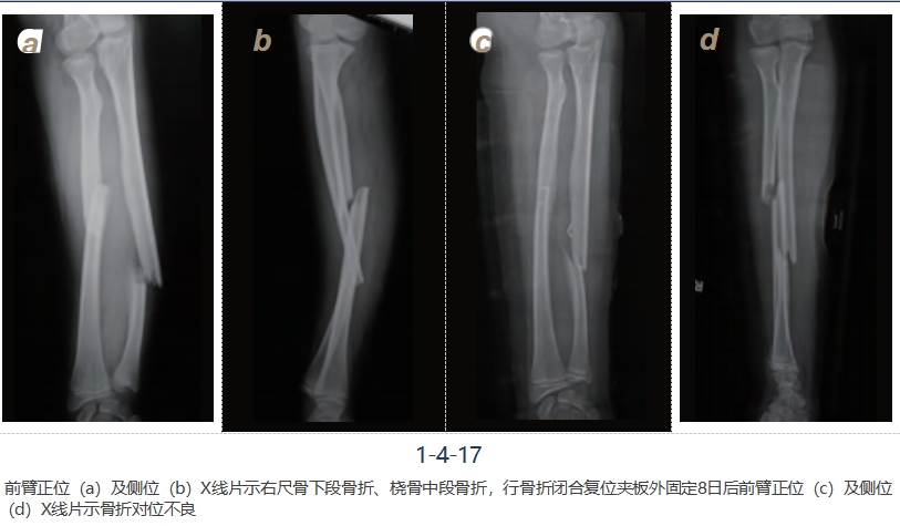 儿童尺桡骨干骨折弹性髓内钉技术（看完这篇就够了）