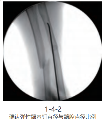 儿童尺桡骨干骨折弹性髓内钉技术（看完这篇就够了）