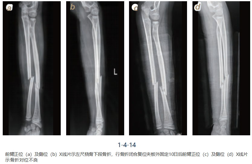 儿童尺桡骨干骨折弹性髓内钉技术（看完这篇就够了）