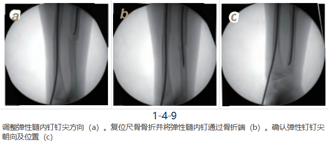 儿童尺桡骨干骨折弹性髓内钉技术（看完这篇就够了）
