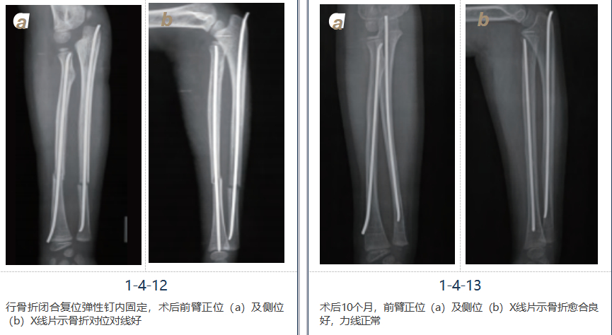 儿童尺桡骨干骨折弹性髓内钉技术（看完这篇就够了）