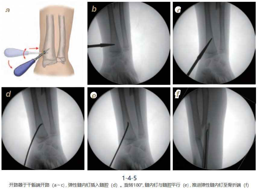 儿童尺桡骨干骨折弹性髓内钉技术（看完这篇就够了）