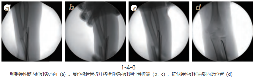 儿童尺桡骨干骨折弹性髓内钉技术（看完这篇就够了）