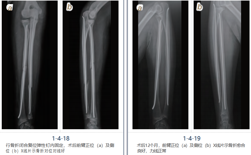 儿童尺桡骨干骨折弹性髓内钉技术（看完这篇就够了）