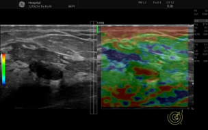 logiq e怎么读【精准医疗 影像先行】五代超高端全身应用彩色多普勒超声诊断仪GE LOGIQ E11在我院投入使用_https://www.jmylbn.com_新闻资讯_第8张