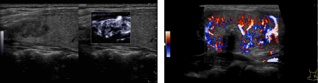 logiq e怎么读【精准医疗 影像先行】五代超高端全身应用彩色多普勒超声诊断仪GE LOGIQ E11在我院投入使用_https://www.jmylbn.com_新闻资讯_第7张