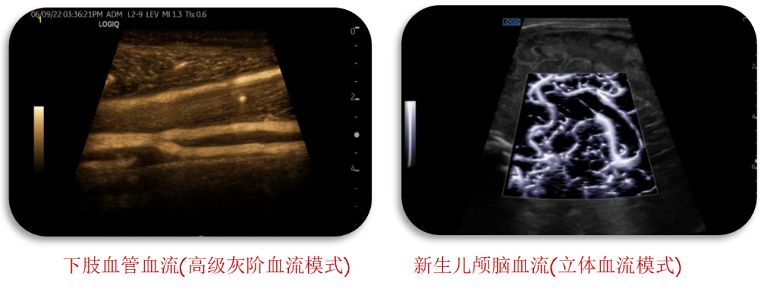 logiq e怎么读【精准医疗 影像先行】五代超高端全身应用彩色多普勒超声诊断仪GE LOGIQ E11在我院投入使用_https://www.jmylbn.com_新闻资讯_第9张