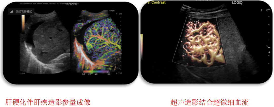 logiq e怎么读【精准医疗 影像先行】五代超高端全身应用彩色多普勒超声诊断仪GE LOGIQ E11在我院投入使用_https://www.jmylbn.com_新闻资讯_第10张