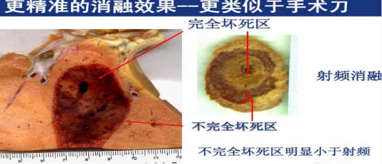 氦氩刀是什么【每日一方】氩氦刀-让肿瘤感受冰火两重天！_https://www.jmylbn.com_新闻资讯_第3张