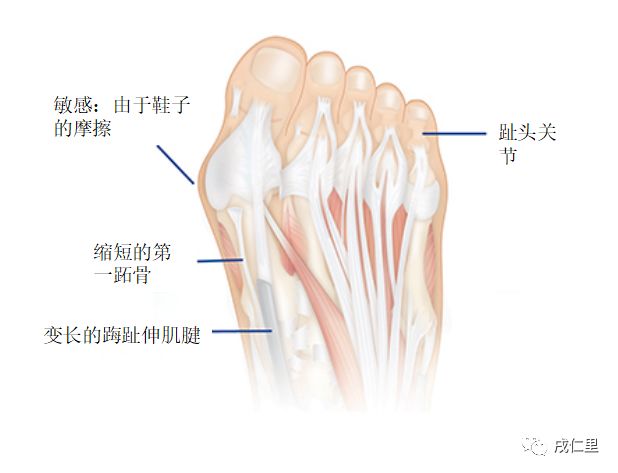 拇囊炎 戌仁里 微信公众号文章阅读 Wemp