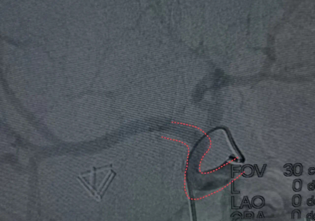 不会导管导丝基本操作?