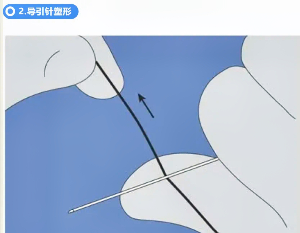 不会导管导丝基本操作?