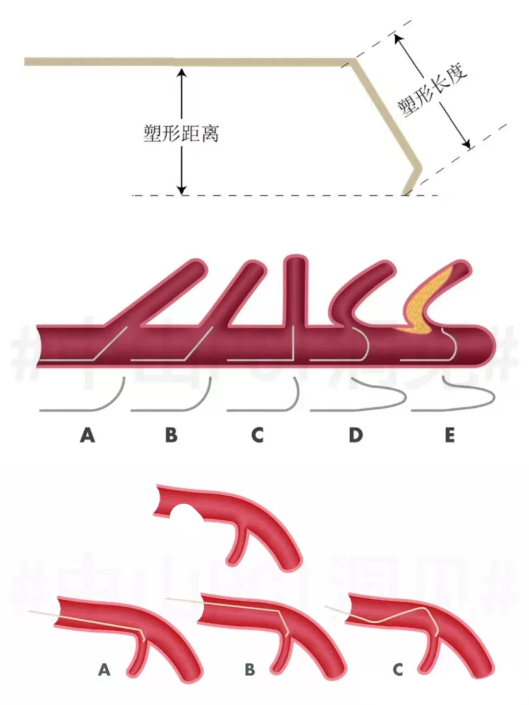 不会导管导丝基本操作?