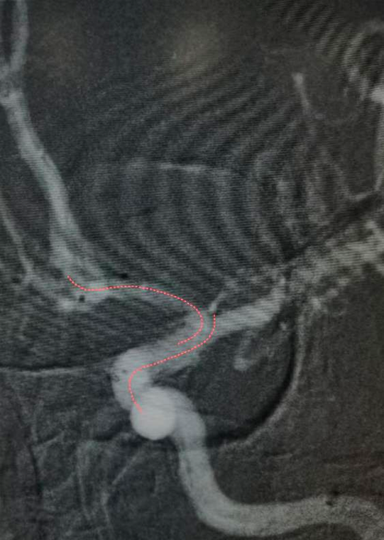 不会导管导丝基本操作?