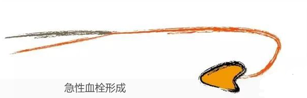 详细图解经桡动脉导管打折的处理方法