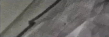 详细图解经桡动脉导管打折的处理方法
