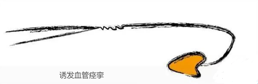 详细图解经桡动脉导管打折的处理方法