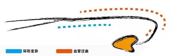 详细图解经桡动脉导管打折的处理方法