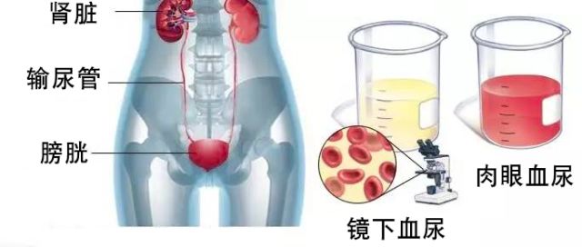 这是一个重要的疾病信号：血尿！