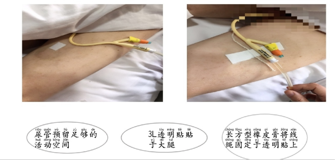 体表导管固定怎么使用【专科护理】牢固定  与“脱管”说再见--导管固定贴这样使用更轻松_https://www.jmylbn.com_新闻资讯_第9张