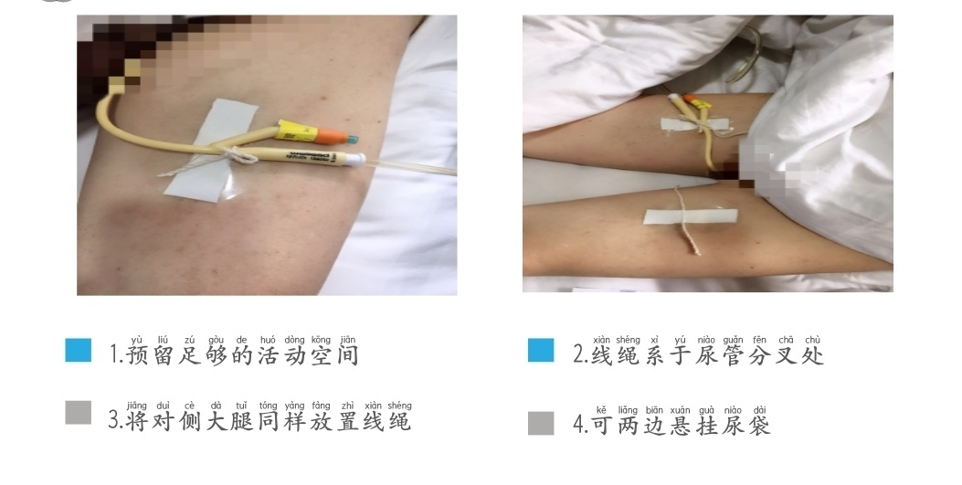 体表导管固定怎么使用【专科护理】牢固定  与“脱管”说再见--导管固定贴这样使用更轻松_https://www.jmylbn.com_新闻资讯_第10张