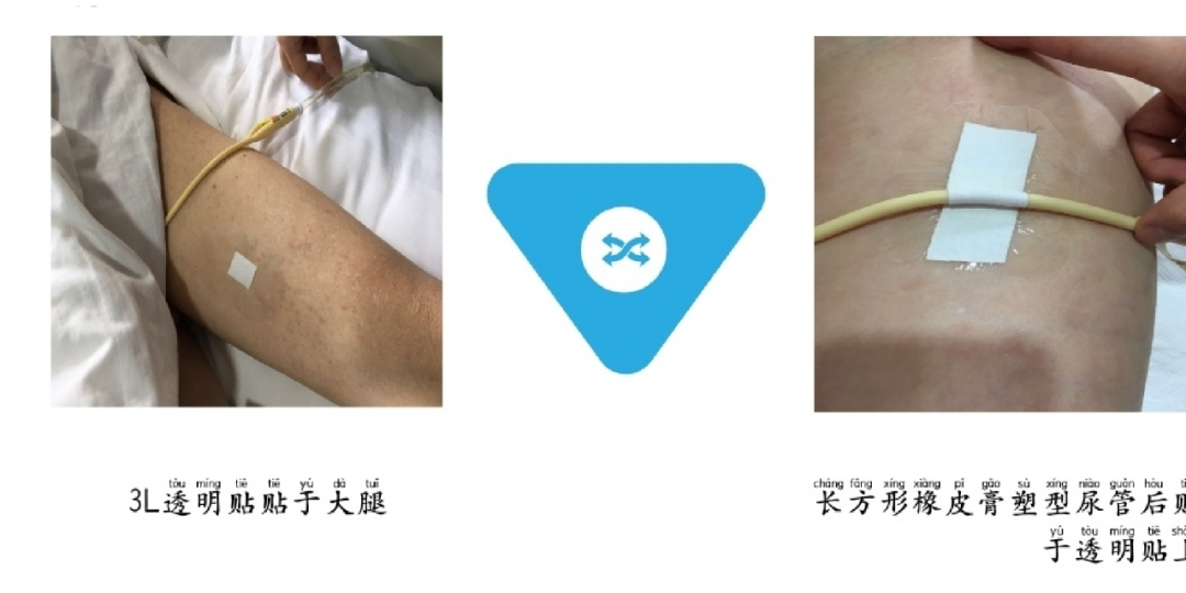 体表导管固定怎么使用【专科护理】牢固定  与“脱管”说再见--导管固定贴这样使用更轻松_https://www.jmylbn.com_新闻资讯_第6张