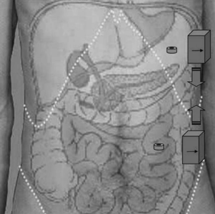 胃肠吻合时需要哪些器械【干货收藏】内镜下胃肠吻合术之磁体吻合_https://www.jmylbn.com_新闻资讯_第7张