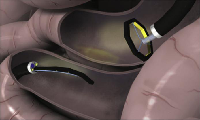 胃肠吻合时需要哪些器械【干货收藏】内镜下胃肠吻合术之磁体吻合_https://www.jmylbn.com_新闻资讯_第3张