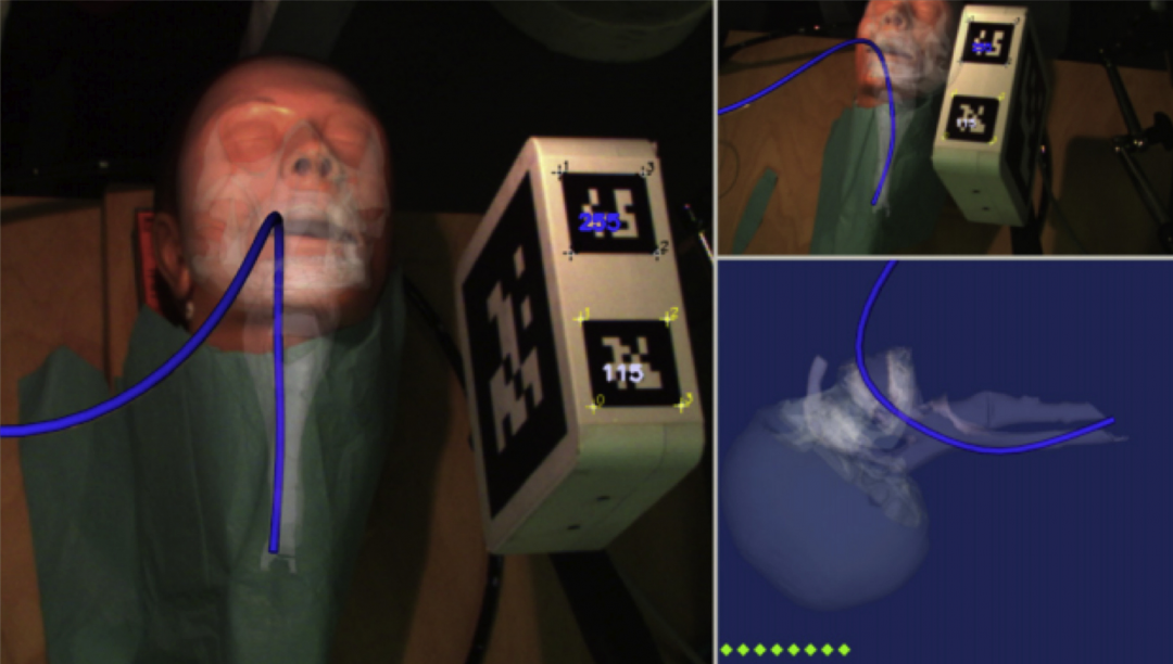 胃肠吻合时需要哪些器械【干货收藏】内镜下胃肠吻合术之磁体吻合_https://www.jmylbn.com_新闻资讯_第5张