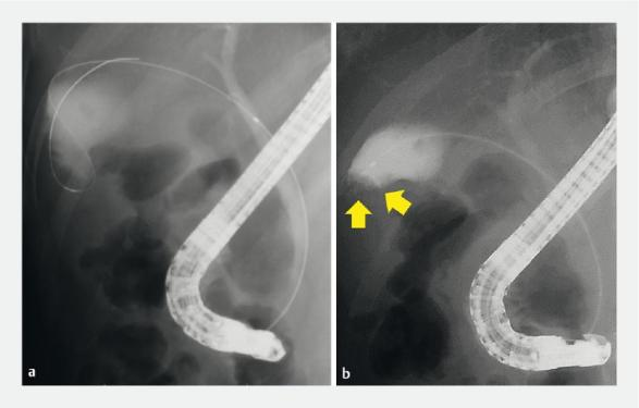 活检钳怎么用【京都大学】胆囊肿瘤活检新技术：使用支架输送系统和活检钳_https://www.jmylbn.com_新闻资讯_第3张