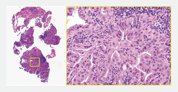 活检钳怎么用【京都大学】胆囊肿瘤活检新技术：使用支架输送系统和活检钳_https://www.jmylbn.com_新闻资讯_第5张