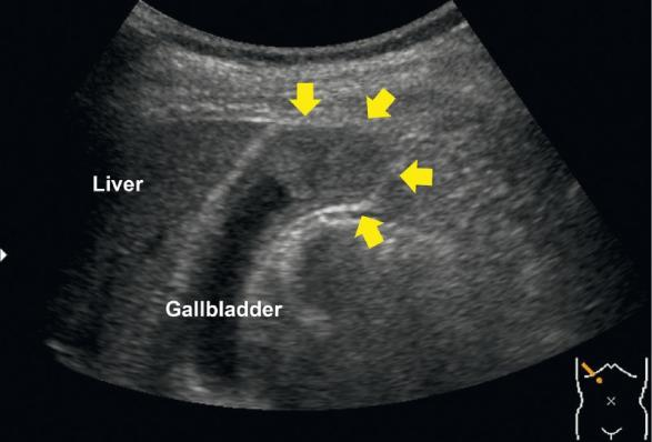 活检钳怎么用【京都大学】胆囊肿瘤活检新技术：使用支架输送系统和活检钳_https://www.jmylbn.com_新闻资讯_第1张