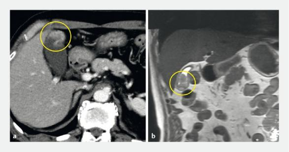活检钳怎么用【京都大学】胆囊肿瘤活检新技术：使用支架输送系统和活检钳_https://www.jmylbn.com_新闻资讯_第2张