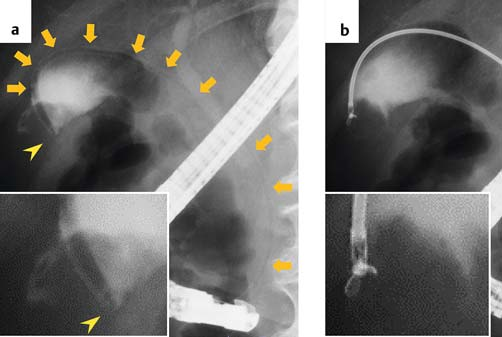 活检钳怎么用【京都大学】胆囊肿瘤活检新技术：使用支架输送系统和活检钳_https://www.jmylbn.com_新闻资讯_第6张