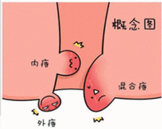 促愈凝胶怎么排出「DR.ROTUS卡波姆痔疮凝胶」消肿止痛，止血止痒，促进愈合_https://www.jmylbn.com_新闻资讯_第30张