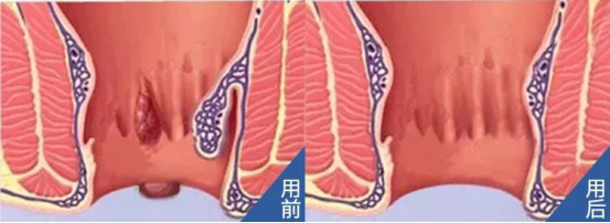 促愈凝胶怎么排出「DR.ROTUS卡波姆痔疮凝胶」消肿止痛，止血止痒，促进愈合_https://www.jmylbn.com_新闻资讯_第42张