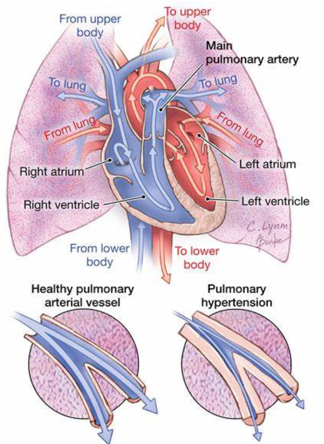 心脏磁共振助力肺动脉高压诊疗