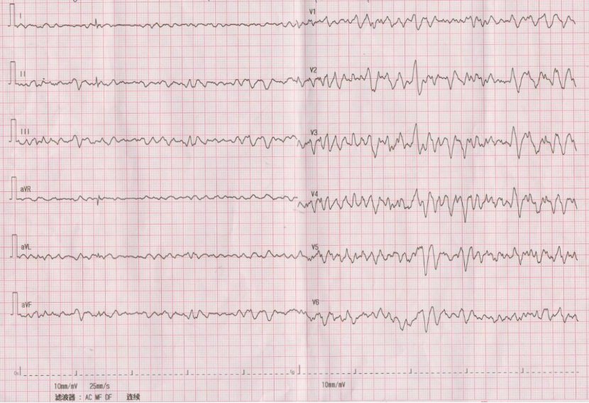 心电图怎么开手动患者在监护室室颤了，真的有医生大错特错的先干了这个！_https://www.jmylbn.com_新闻资讯_第1张