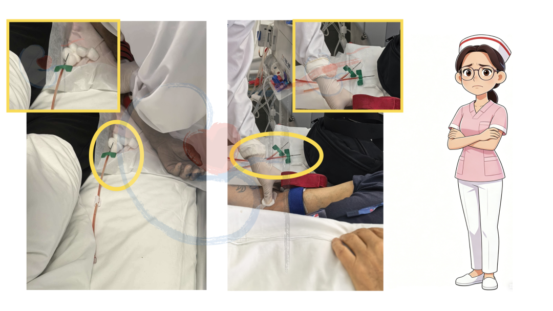 穿刺针怎么用透析护士｜使用后的透析用穿刺针，应如何处理呢？_https://www.jmylbn.com_新闻资讯_第4张