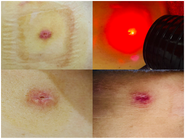 激光疗法有什么作用【五里微课堂】一束神奇的光，治愈身体的魔法_https://www.jmylbn.com_新闻资讯_第8张