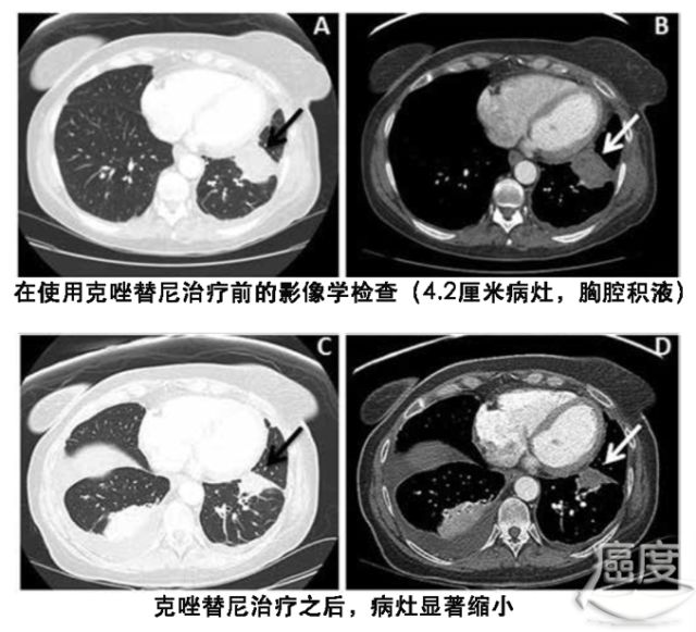 kras基因exon4突变_kras基因突变_kras基因