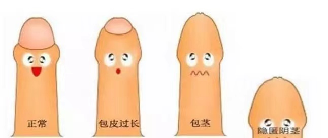 包皮自动切除环怎么用男孩的专属福利｜徽县中医医院开展儿童微创包皮环切术_https://www.jmylbn.com_新闻资讯_第3张