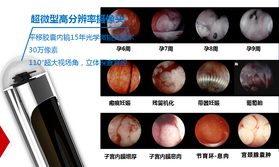 人流吸引管怎么选择宫腔直视人流技术，避免盲刮，看得见的关爱_https://www.jmylbn.com_新闻资讯_第5张
