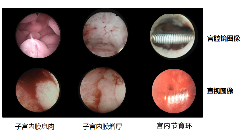 人流吸引管怎么选择宫腔直视人流技术，避免盲刮，看得见的关爱_https://www.jmylbn.com_新闻资讯_第8张