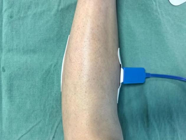 为什么手术用电刀外科医生的“魔法刀”：揭秘手术室里的高频电刀​​_https://www.jmylbn.com_新闻资讯_第5张